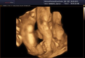 Peter's feet - bilateral clubfoot, 22 weeks